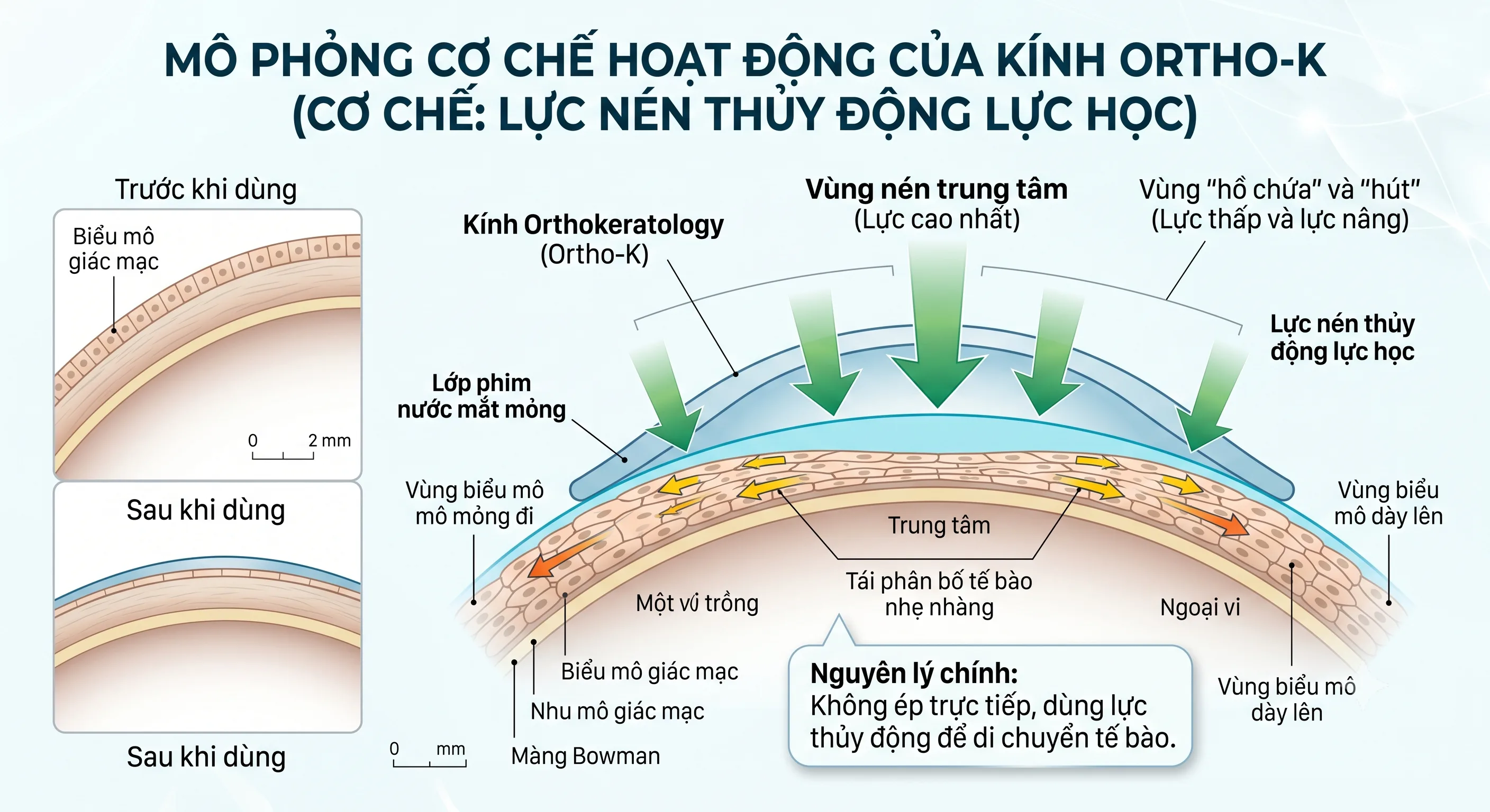 Cơ chế Ortho-K — Lực nén thủy động lực học GOV® XMJ